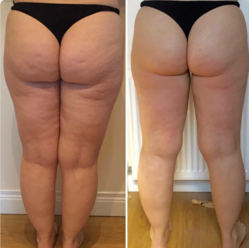 CeluZero® Massageador AntiCelulite